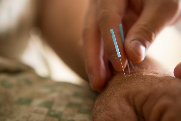 acupuncture needles