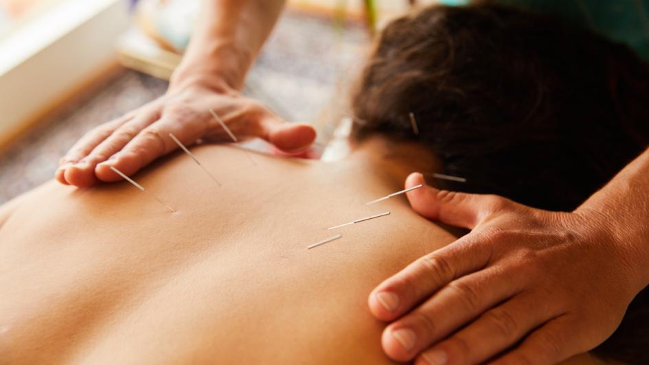 accupuncture
